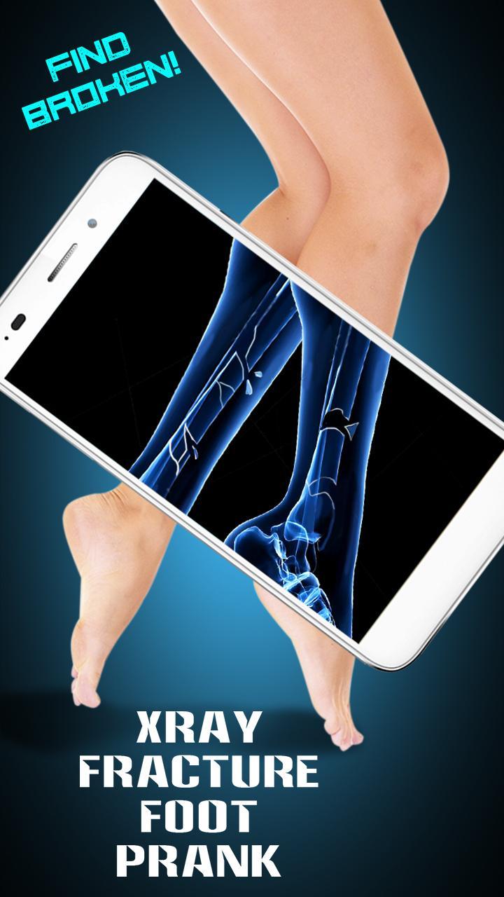 Xray Fracture Foot Prank